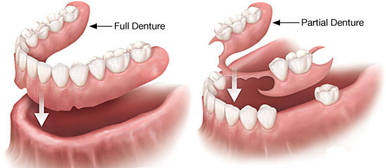 metal free dentures