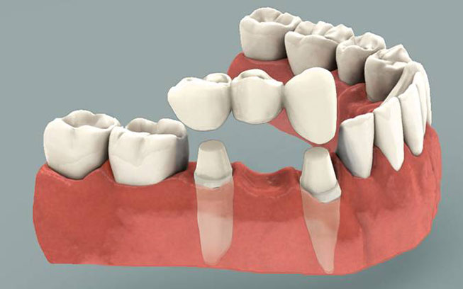 dental bridge melbourne
