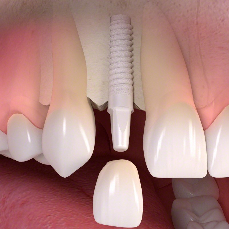 Zirconia Implants Melbourne | Laser + Holistic Dental | Learn More