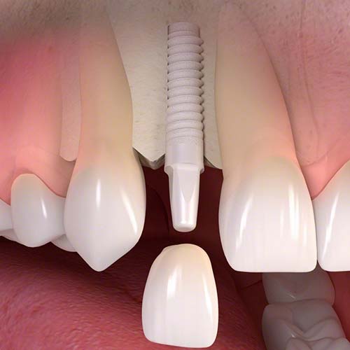 metal free dental implants