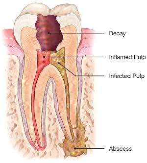 root-canal-abcessed-tooth