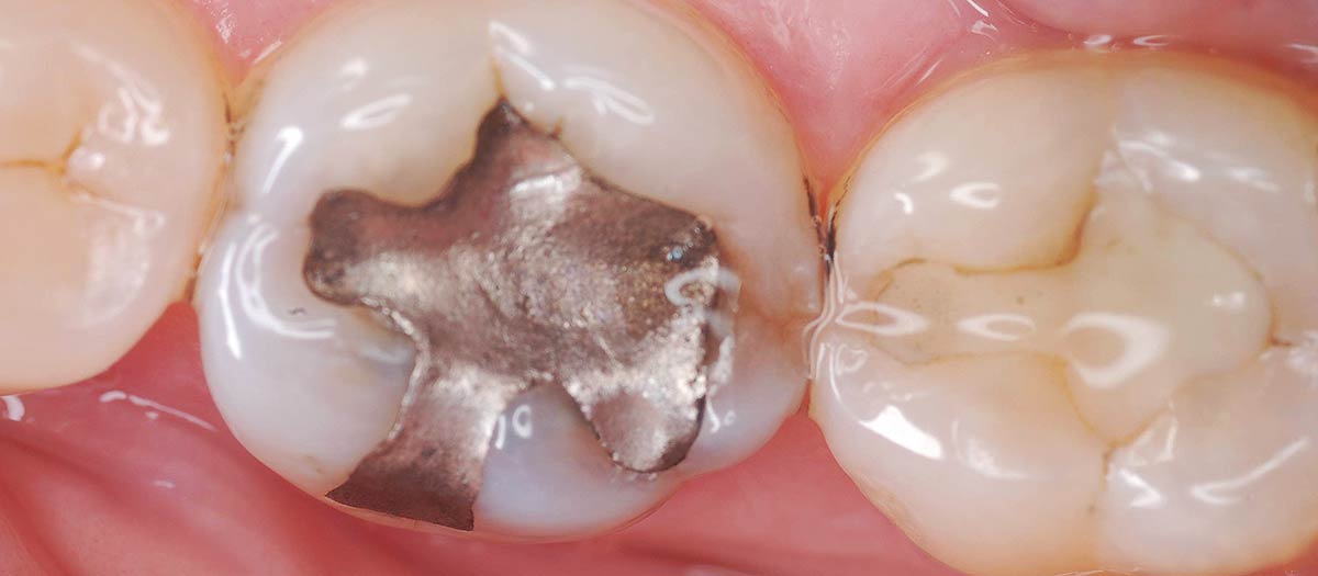 amalgam removal dentist melbourne